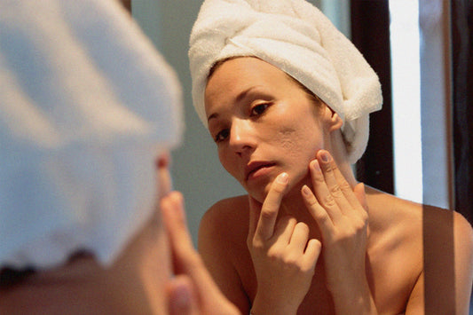 The impact acne has on adult women