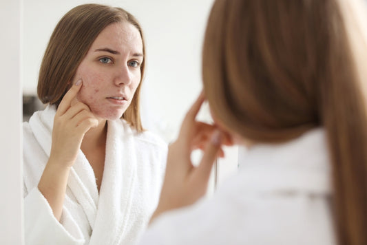 Acne is more than skin deep