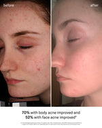 SEEN Acne-Safe Bundle