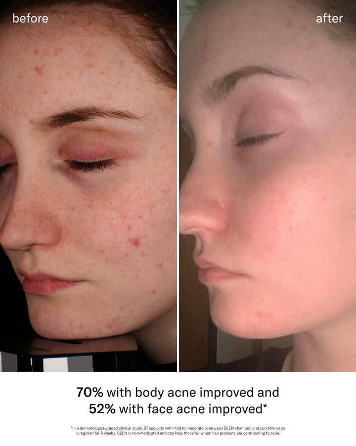 SEEN Acne-Safe Bundle, Fragrance Free