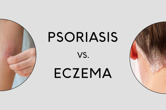 Psoriasis vs. eczema: What you need to know