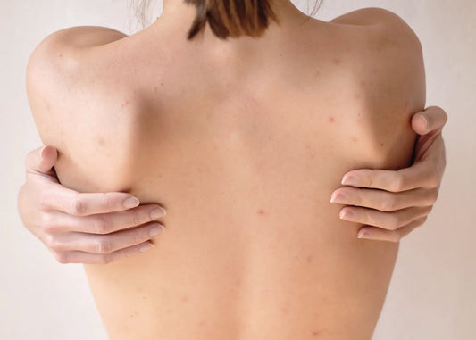 If you experience body acne, you’re not alone